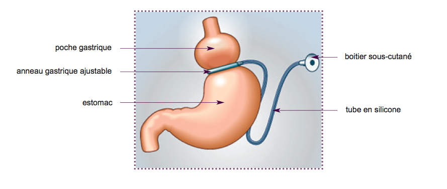 Anneau gastrique tunisie