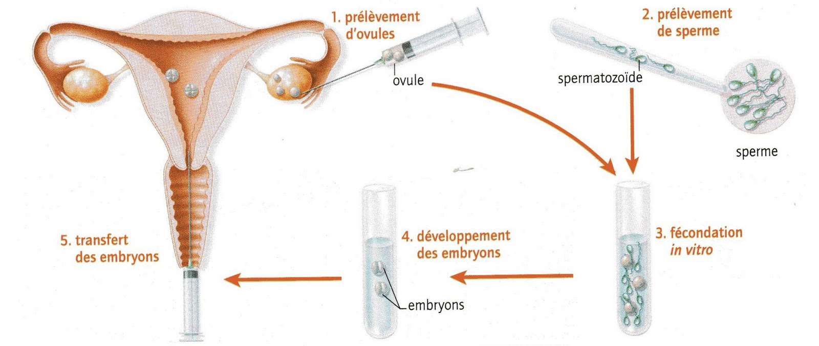 Fécondation in vitro tunisie