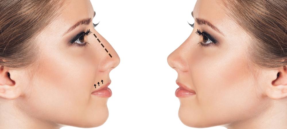 Rhinoplastie Tunisie