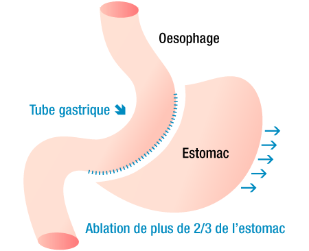 Sleeve gastrectomie Tunisie